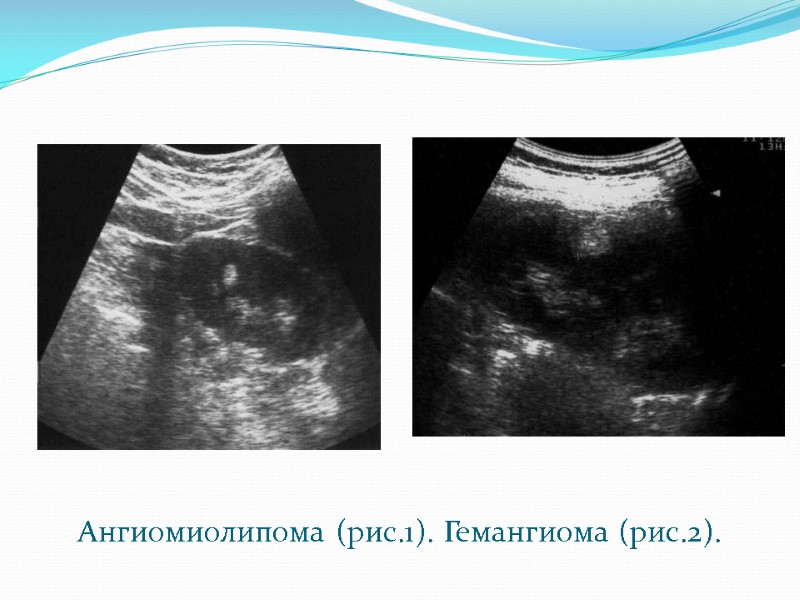Ангиомиолипома (рис.1). Гемангиома (рис.2).